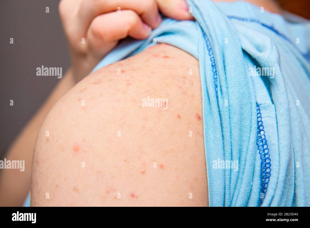 Red Spots On Back Shoulders And Chest at Quyen Elliott blog