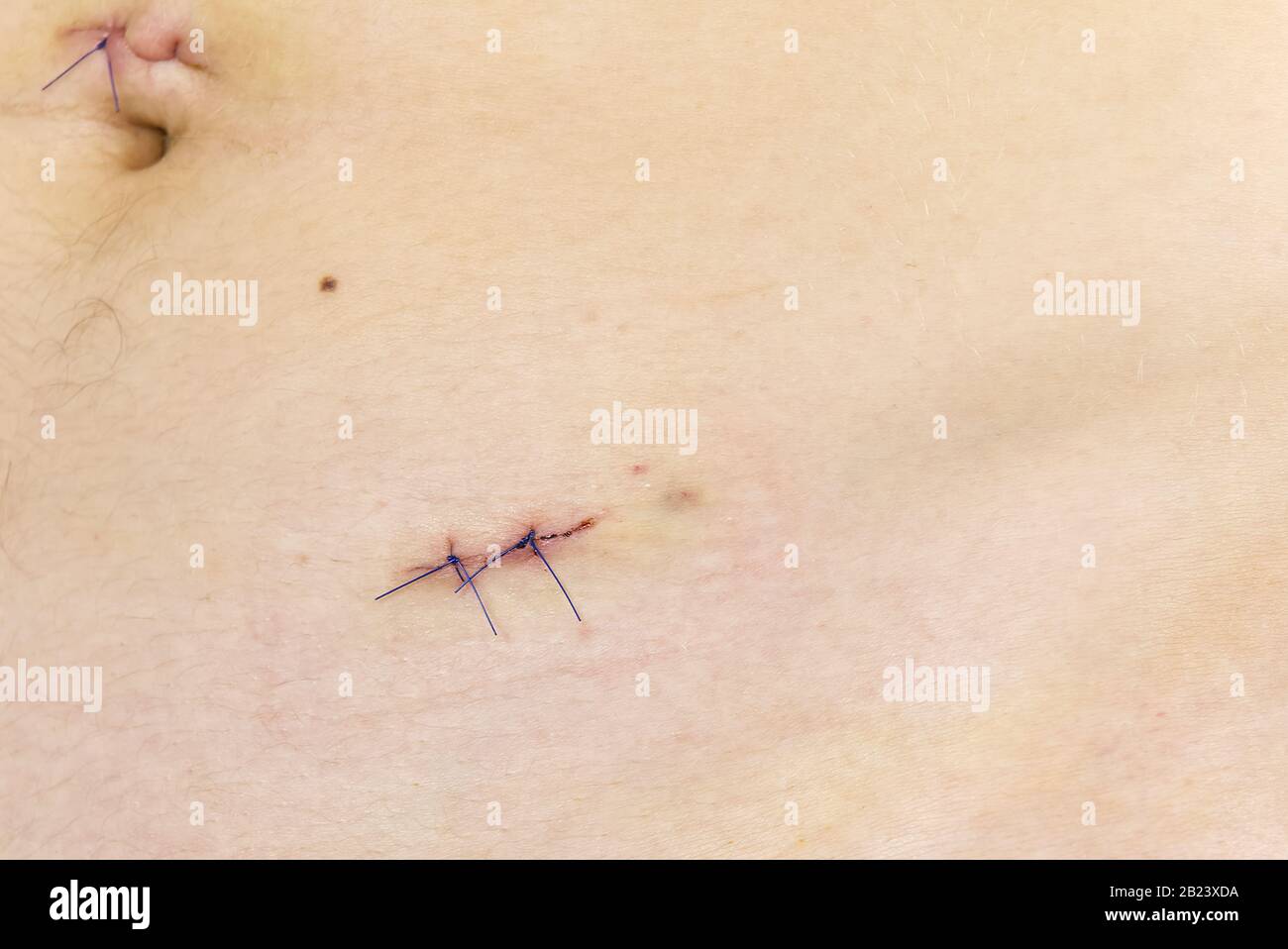 Body scars after appendicitis removal. Small and neat scars after
