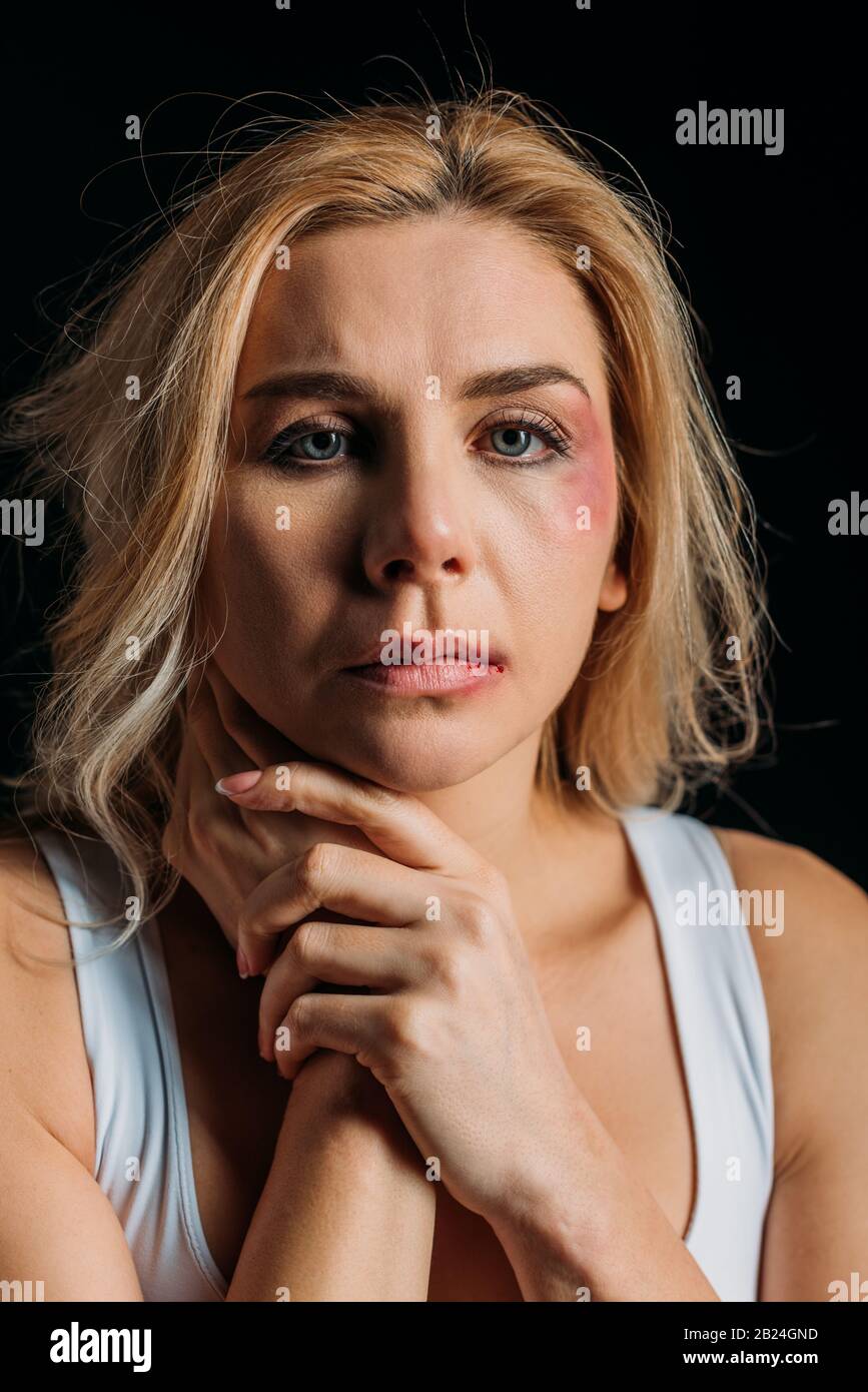 Bruises neck hires stock photography and images Alamy