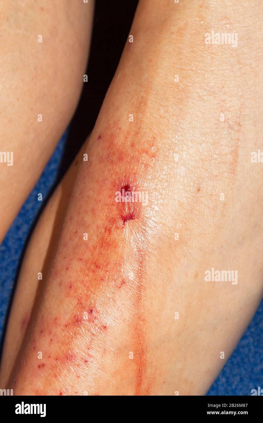 Bloody scratched due to massive itching, Neurodermatitis respectively atopic eczema Stock Photo