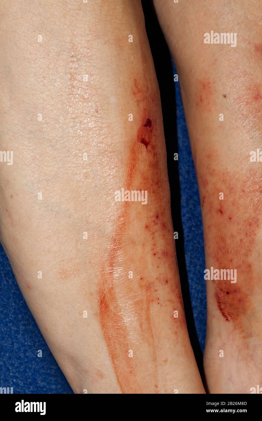 Eczema High Resolution Stock Photography And Images Alamy