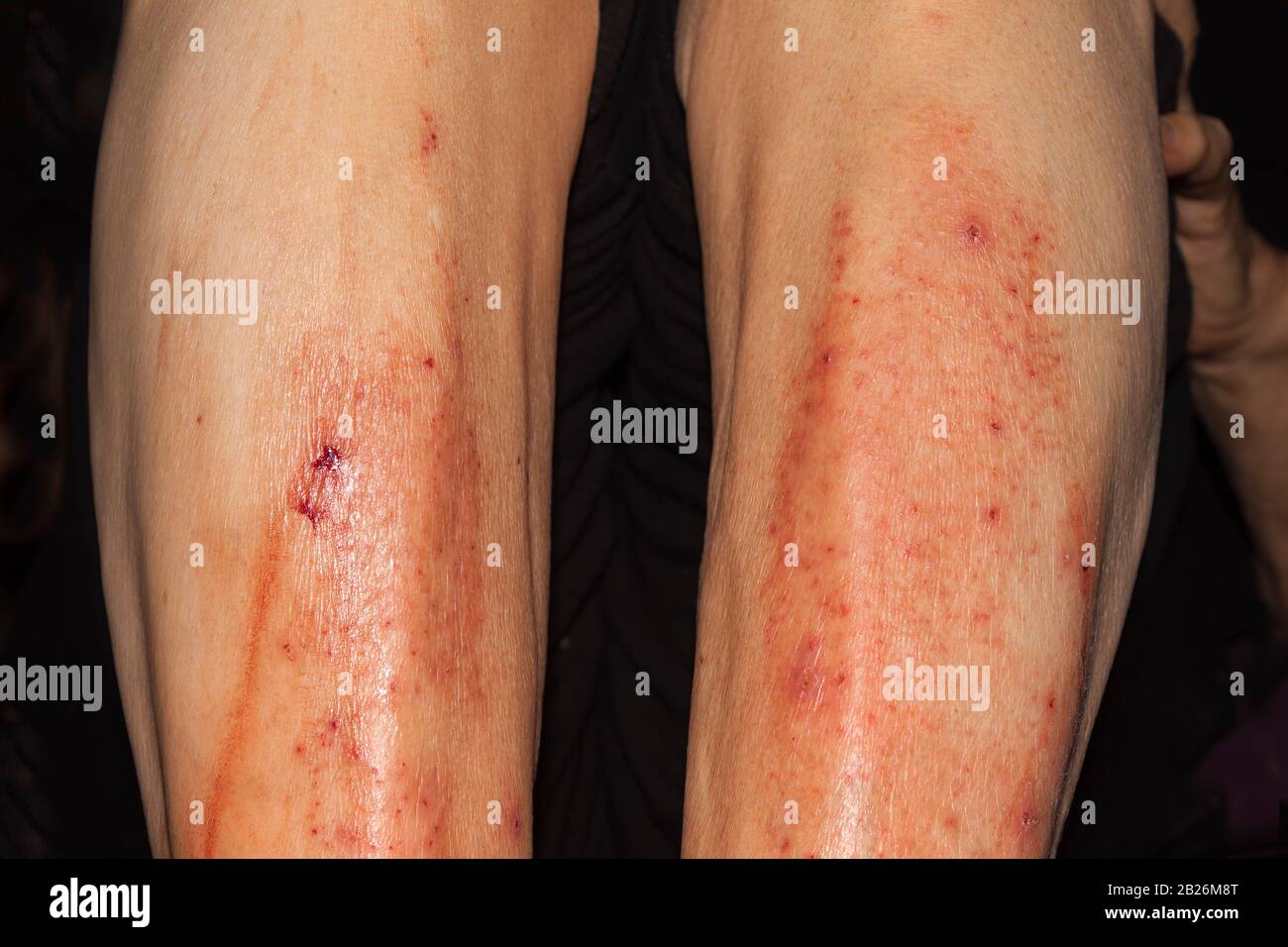 Bloody scratched due to massive itching, Neurodermatitis respectively atopic eczema Stock Photo