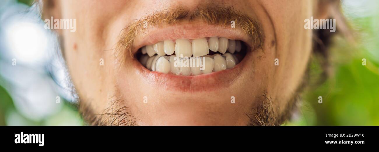 Man placing a bite plate in his mouth to protect his teeth at night from grinding caused by bruxism BANNER, LONG FORMAT Stock Photo