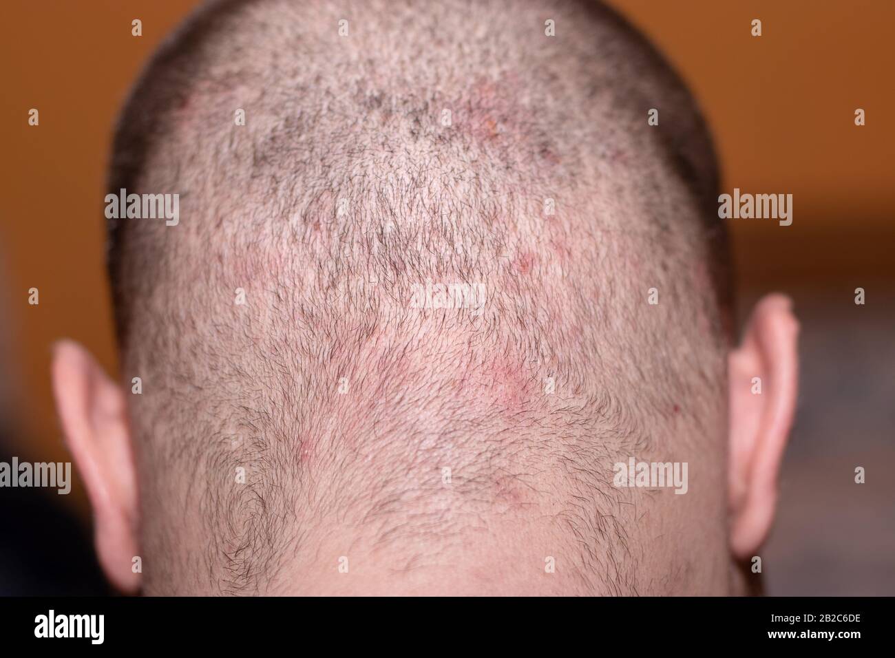 Back view of a bald man's head with short hair suffering from scalp acne.  Small red iritating dots , itchy rash skin problem Stock Photo - Alamy