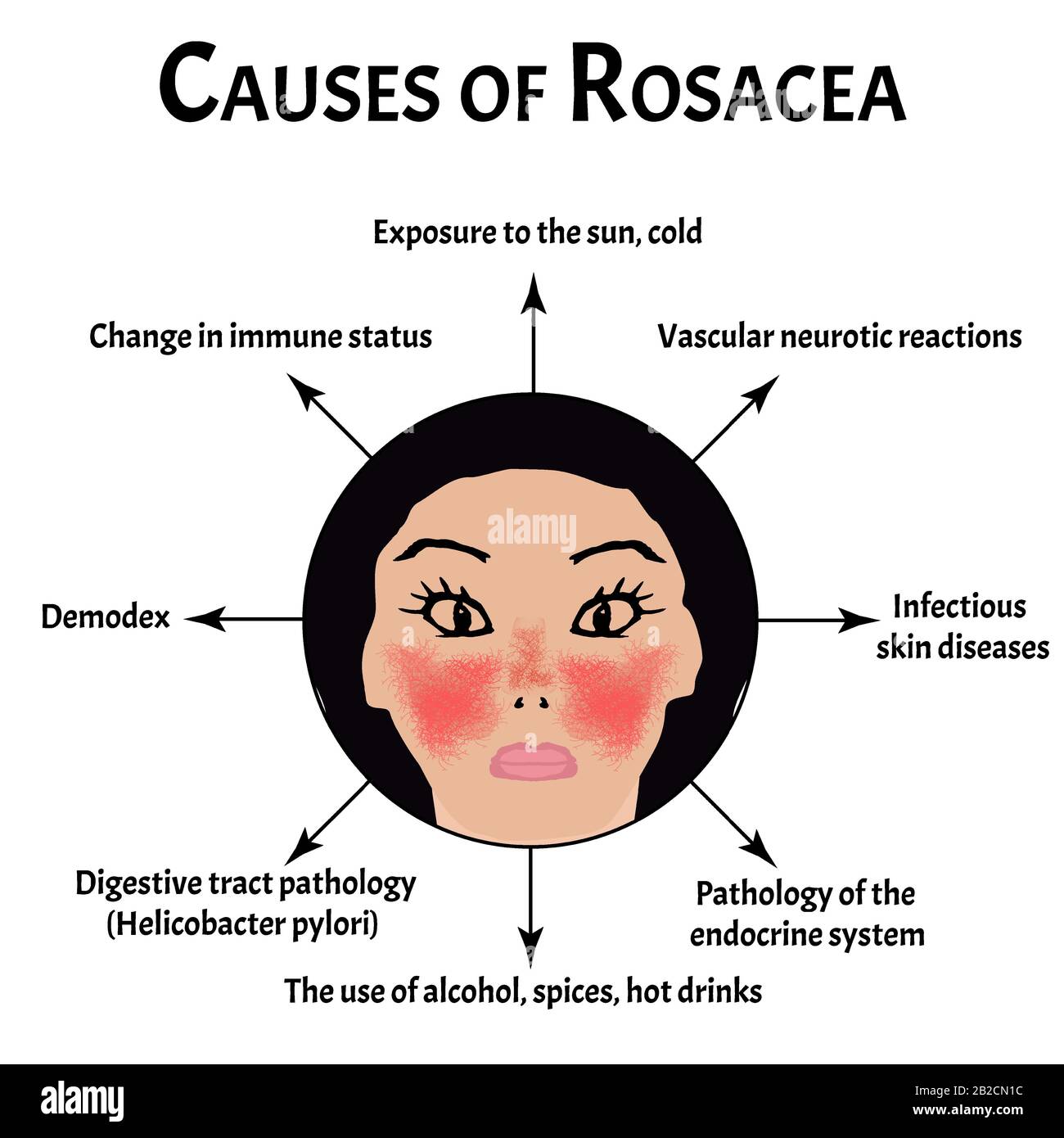 Causes of rosacea. Rosacea Awareness Month. Infographics. Vector ...