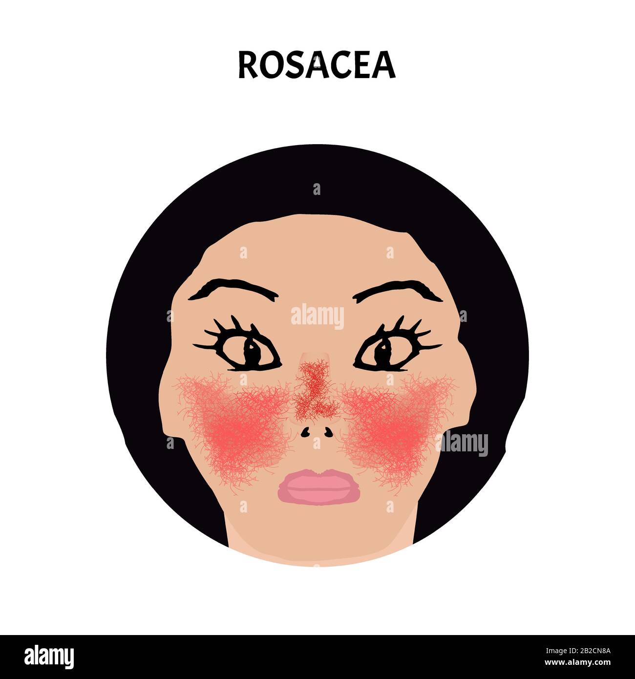 Rosacea. Rosacea Awareness Month. Infographics. Vector illustration on ...