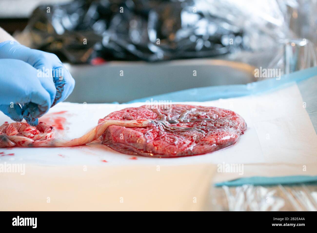 Gloved hands with placenta on white pad attached to umiblical cord. Stock Photo