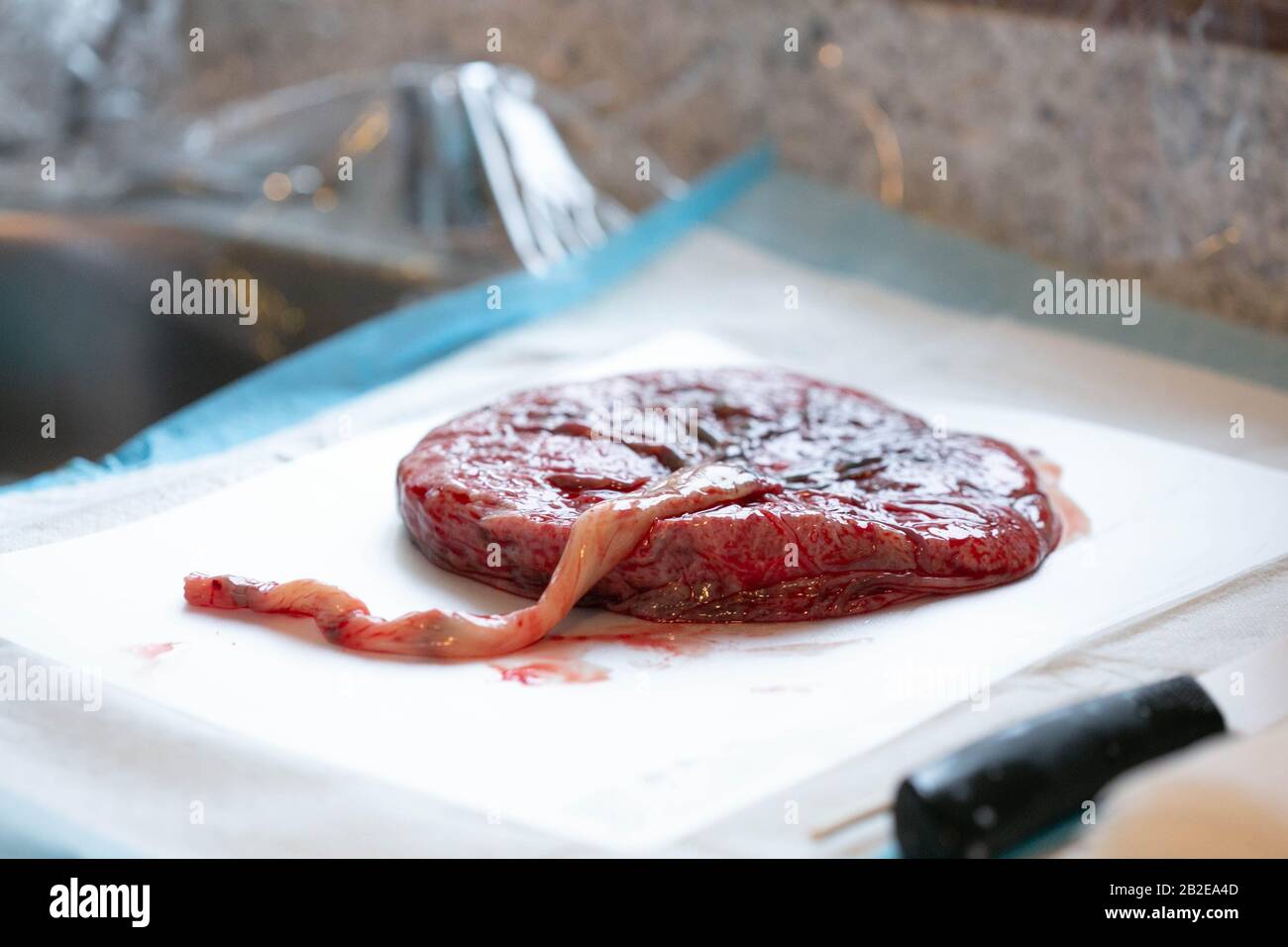Human placenta lying on white pad on countertop visible umbilical cord Stock Photo