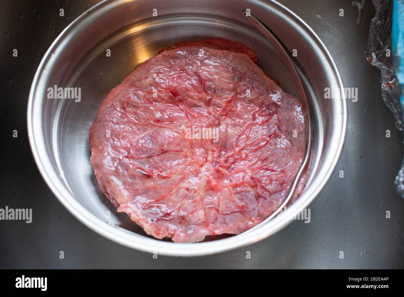 Clean placenta lying in stainless steel bowl in sink. Stock Photo