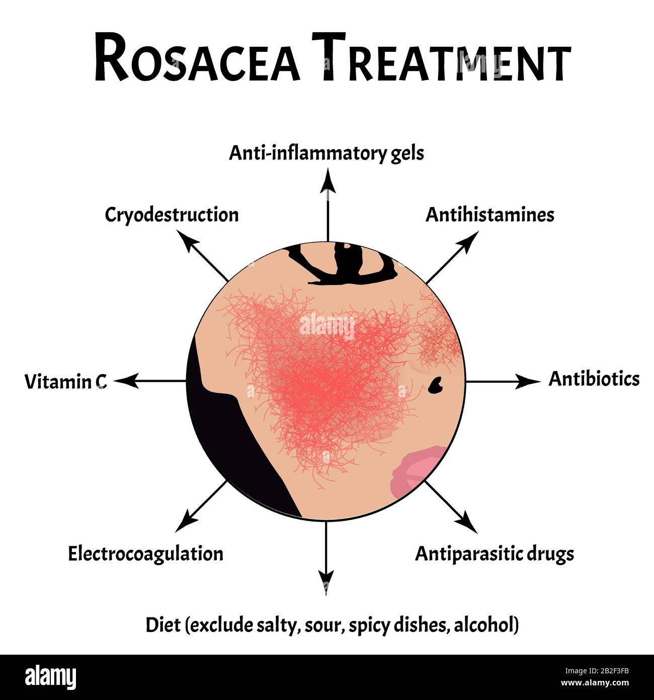 Causes of rosacea. Rosacea Awareness Month. Infographics. Vector