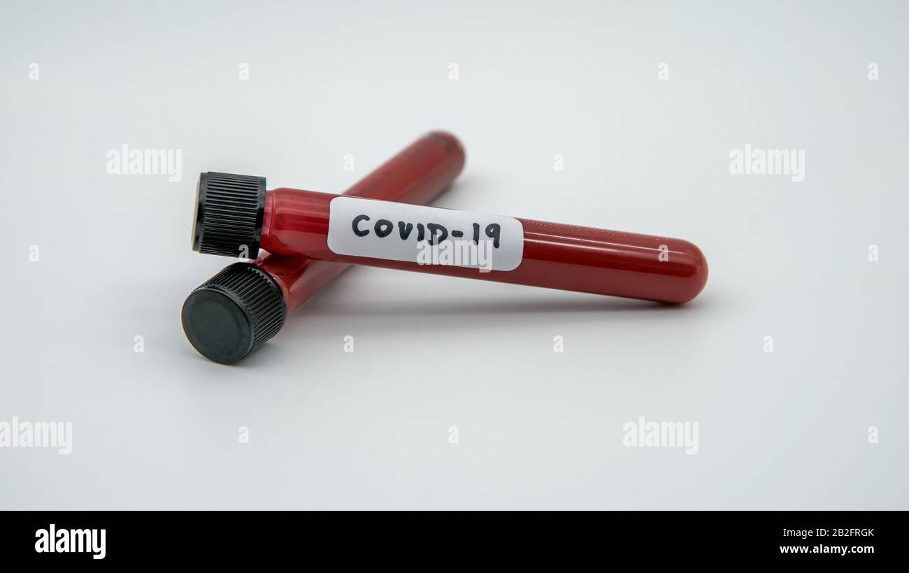 Positive COVID-19 test and laboratory sample of blood testing for diagnosis new Corona virus infection. Disease 2019 from Wuhan. Pandemic infectious c Stock Photo