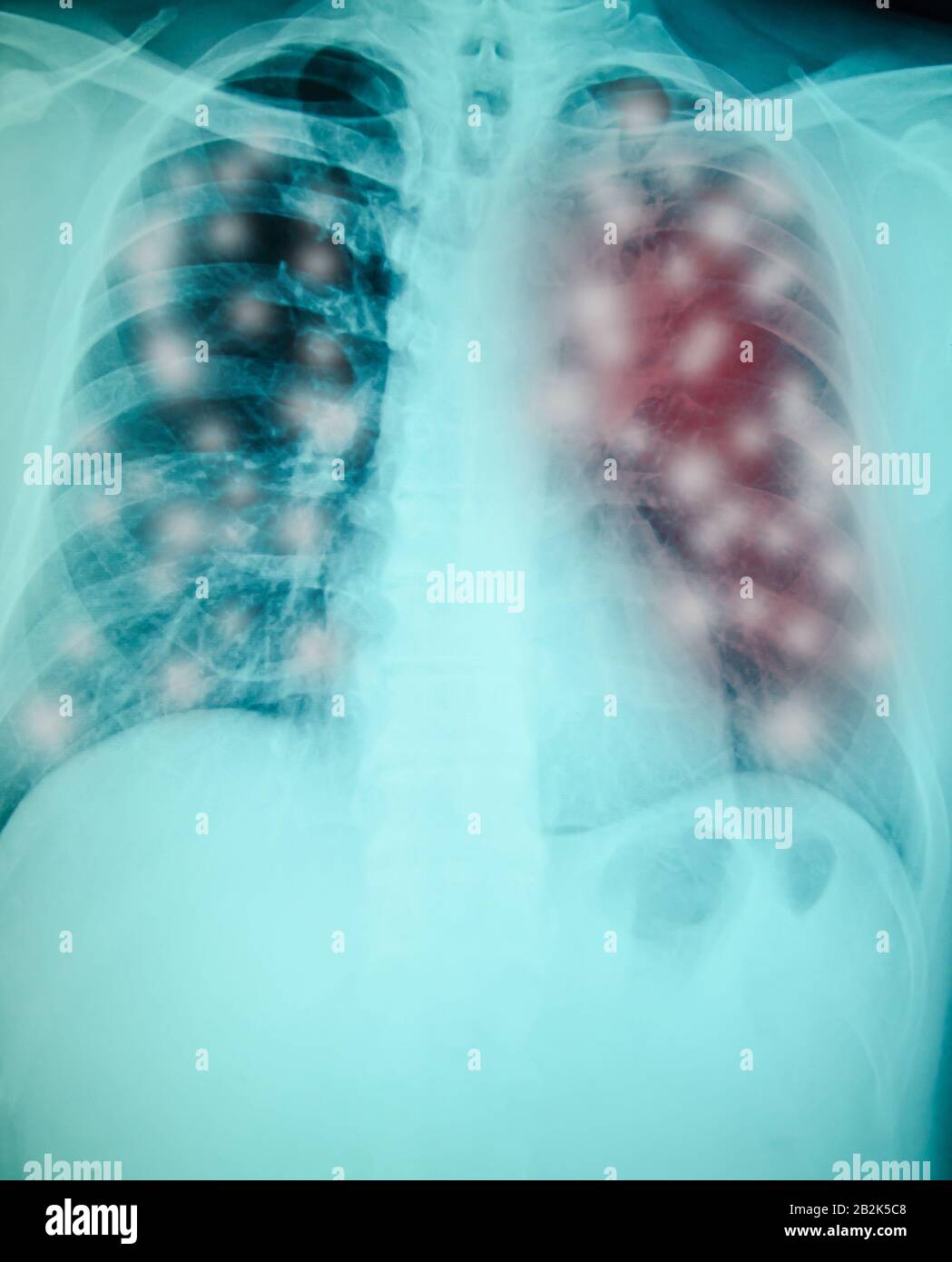 chest x-ray examination for diagnosis Viral  infection with both lung Stock Photo