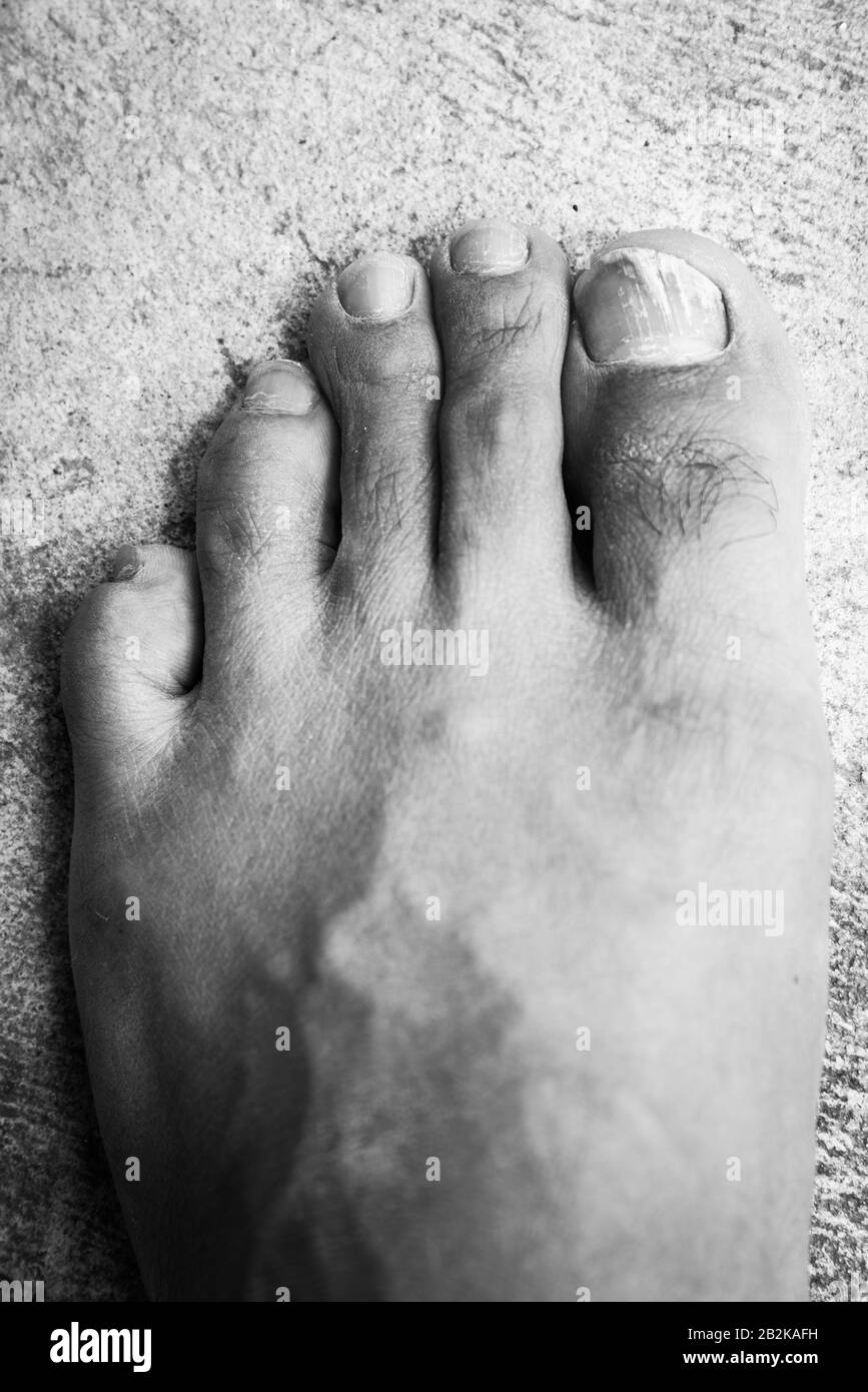 Eczema Black and White Stock Photos & Images Alamy