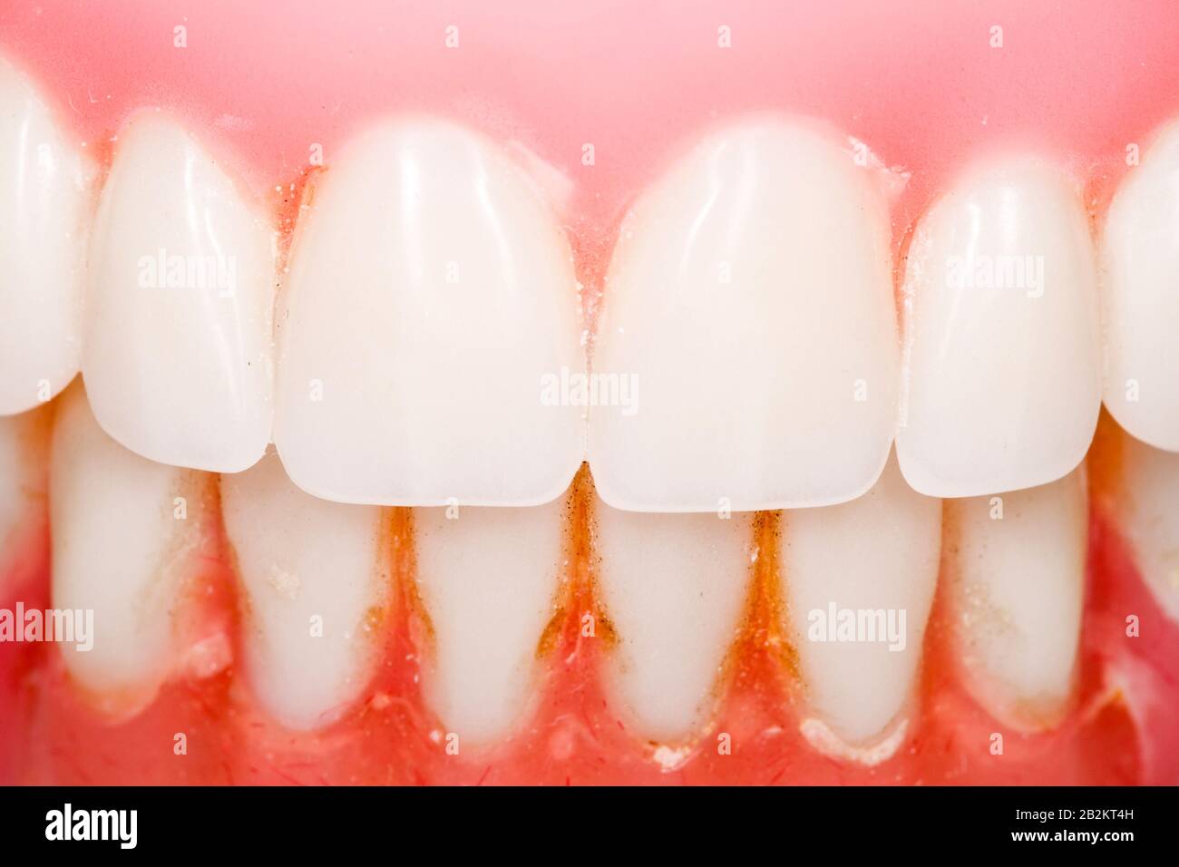 Used Dental Prosthesis Close Up With Visible Plaque Stock Photo Alamy