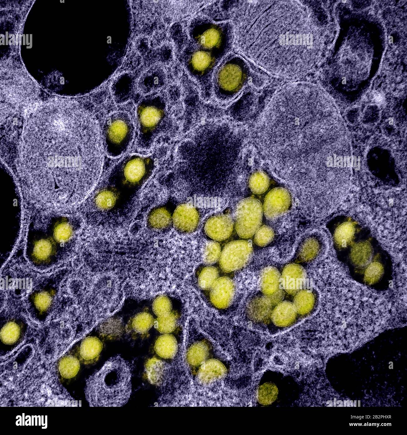 A transmission electron micrograph of COVID-19, novel coronavirus, virus particles, isolated from a patient captured and color-enhanced at the NIAID Integrated Research Facility February 28, 2020 in Fort Detrick, Maryland. Stock Photo