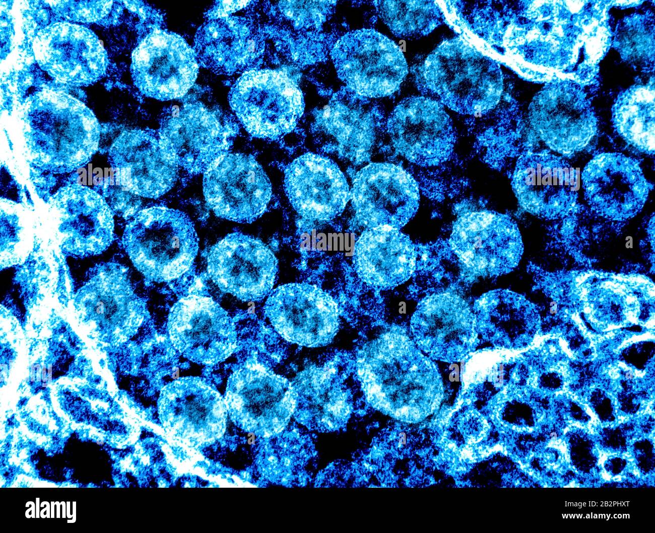 A transmission electron micrograph of COVID-19, novel coronavirus, virus particles, isolated from a patient captured and color-enhanced at the NIAID Integrated Research Facility February 28, 2020 in Fort Detrick, Maryland. Stock Photo