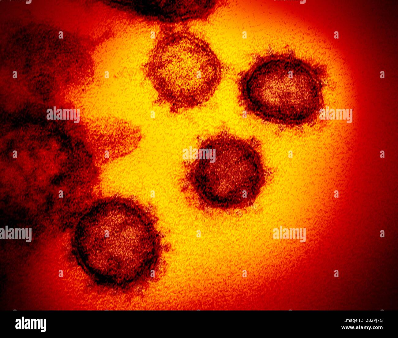 A transmission electron micrograph of COVID-19, novel coronavirus, virus particles, isolated from a patient captured and color-enhanced at the NIAID Integrated Research Facility February 12, 2020 in Fort Detrick, Maryland. Stock Photo