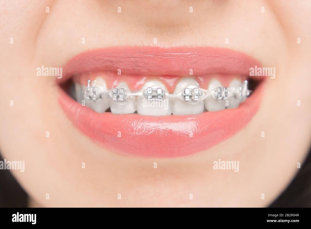 Close Up To Dental Braces Brackets On The Teeth After Whitening Self Ligating Brackets With Metal Ties And Gray Elastics Or Rubber Bands Stock Photo Alamy