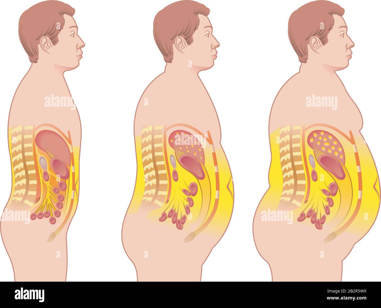 Medical illustration of the consequences of obesity. Stock Vector