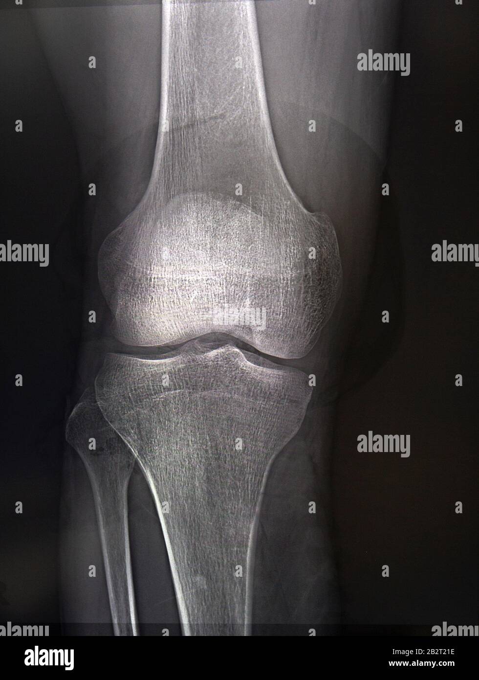 X-rays of the knee joint close up. Medicine Stock Photo - Alamy