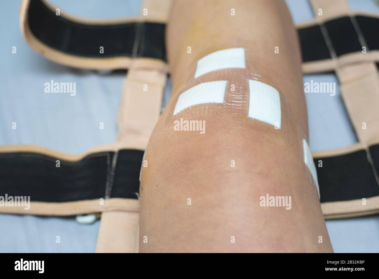 Knee surgery in hospital hi-res stock photography and images - Alamy