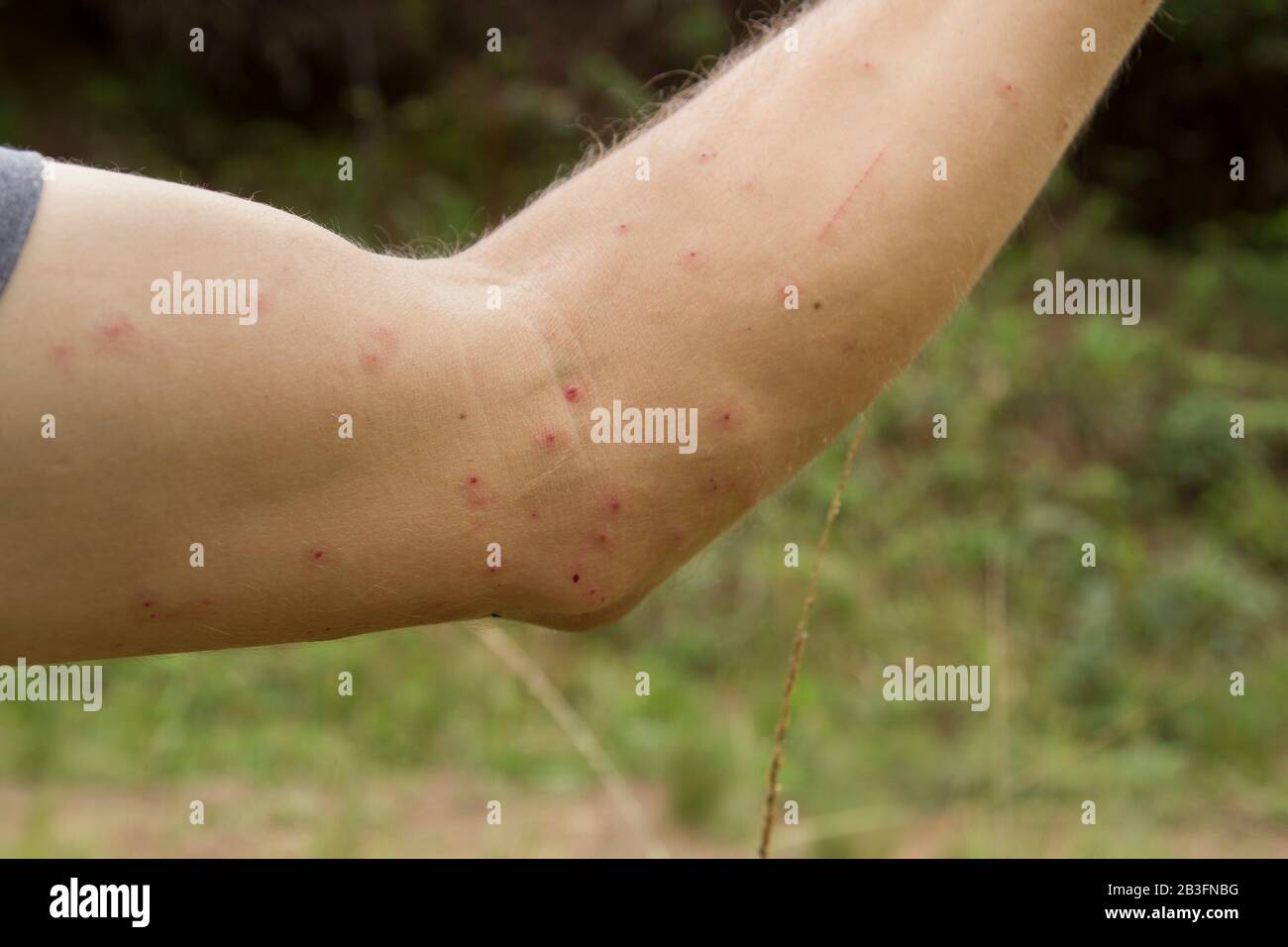 white man showing his arm with hives marks due to mosquito bites Stock  Photo - Alamy