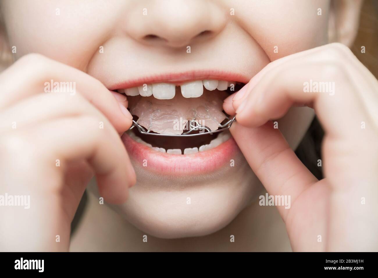 A girl wears a a removable orthodontic appliance. Concept of pediatric dentistry, correcting the