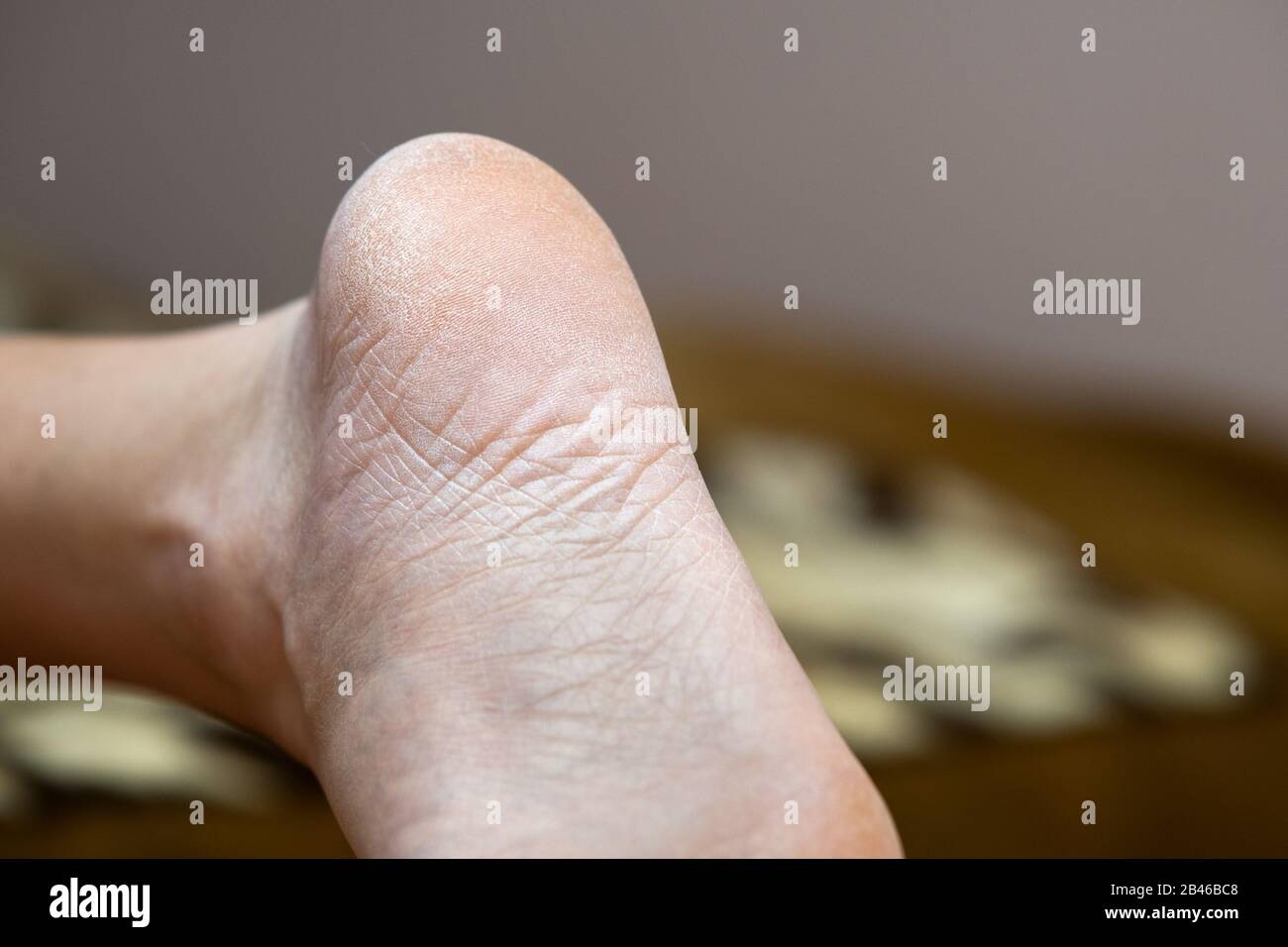 Closeup of woman feet sole with dry cracked skin. Foot and toes care