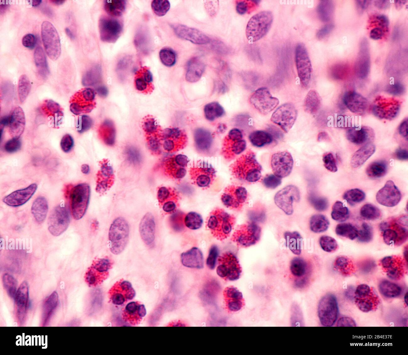 Eosinophil granulocytes in an inflammatory infiltrate. This type of white blood cell is responsible for combating parasites, and have a role in mechan Stock Photo