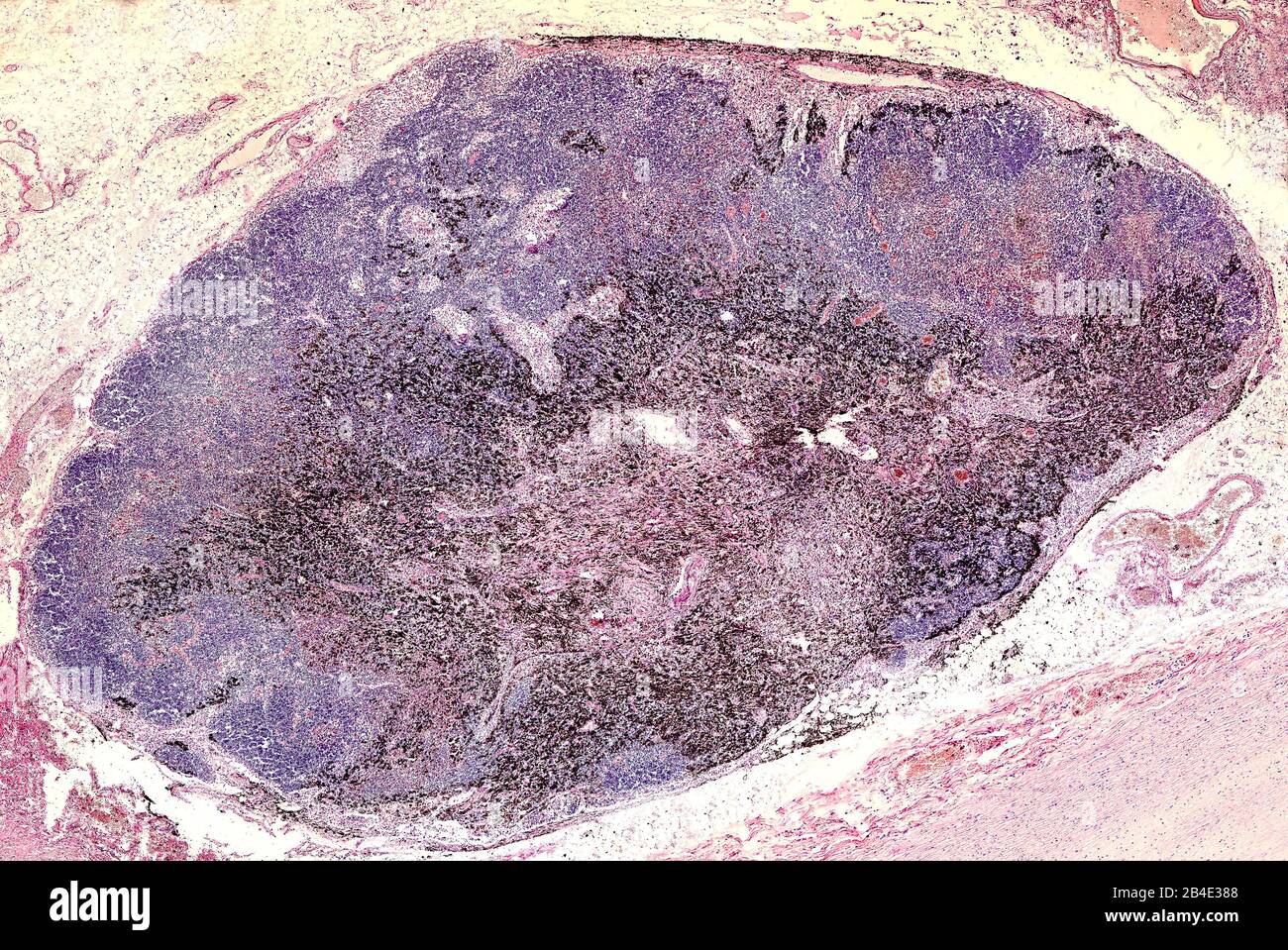 Anthracotic lymph node. Accumulation of carbon is most commonly found in intrapulmonary lymph nodes, due to coal dust, smoke or pollution.  Hematoxyli Stock Photo