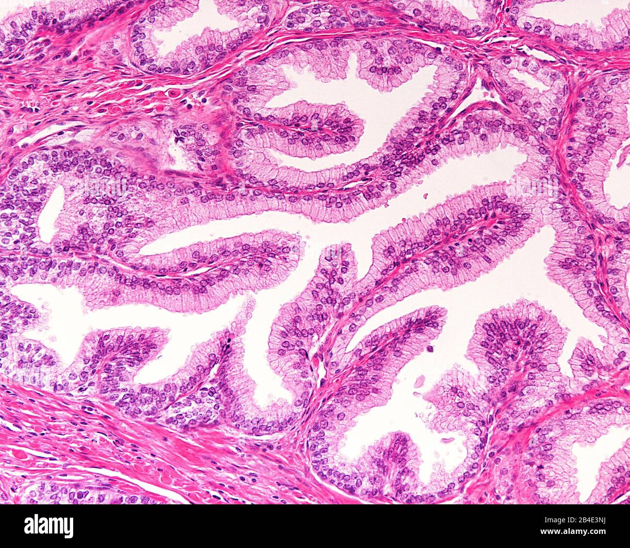 High magnification of a human prostatic gland. A simple columnar epithelium surrounds a very irregular lumen. Hematoxylin & eosin stain. Stock Photo