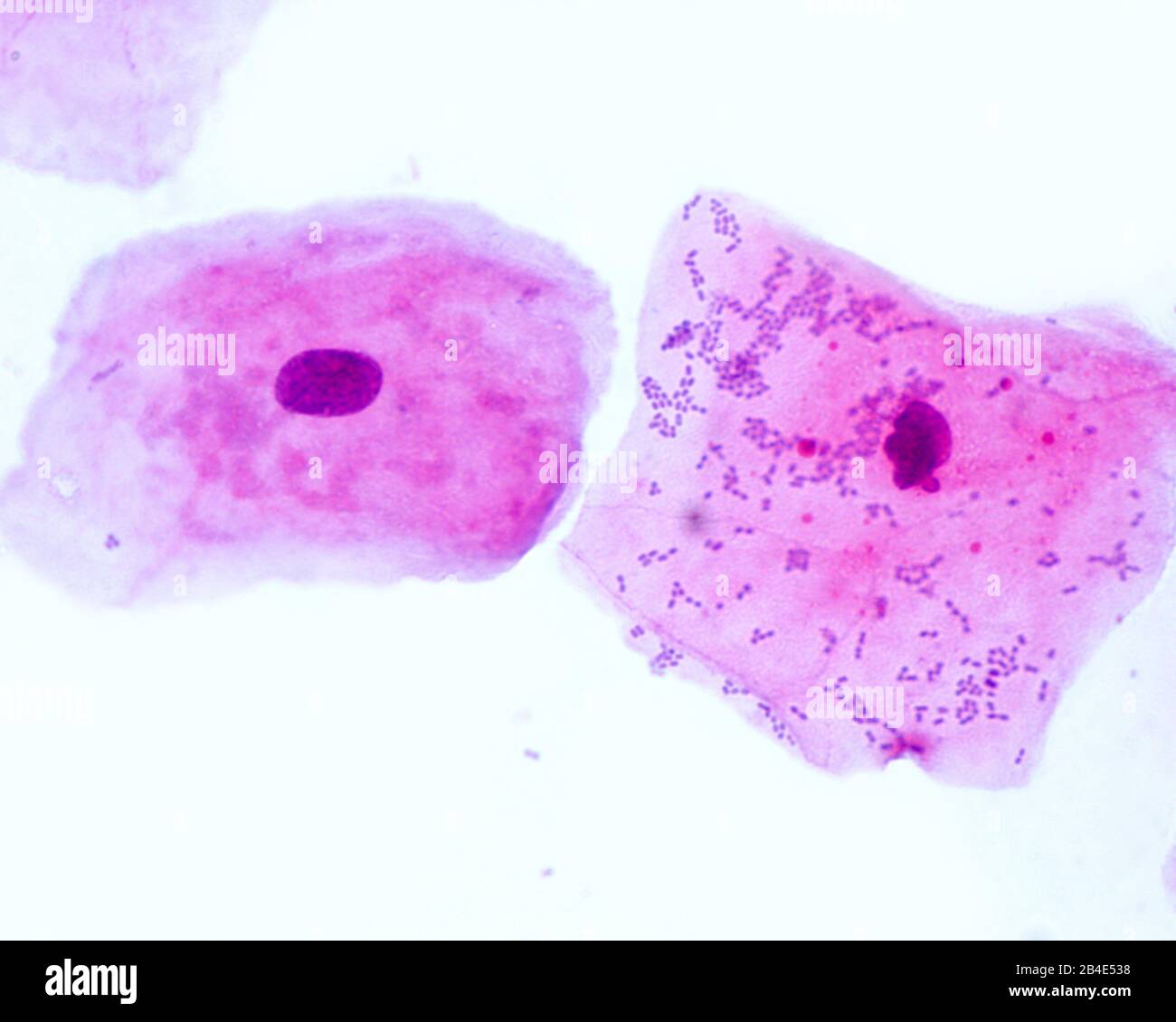 Buccal smear showing squamous epithelial cells exfoliated from the oral mucosae. Small blue dots located mainly on the right cell are bacteria. Stock Photo
