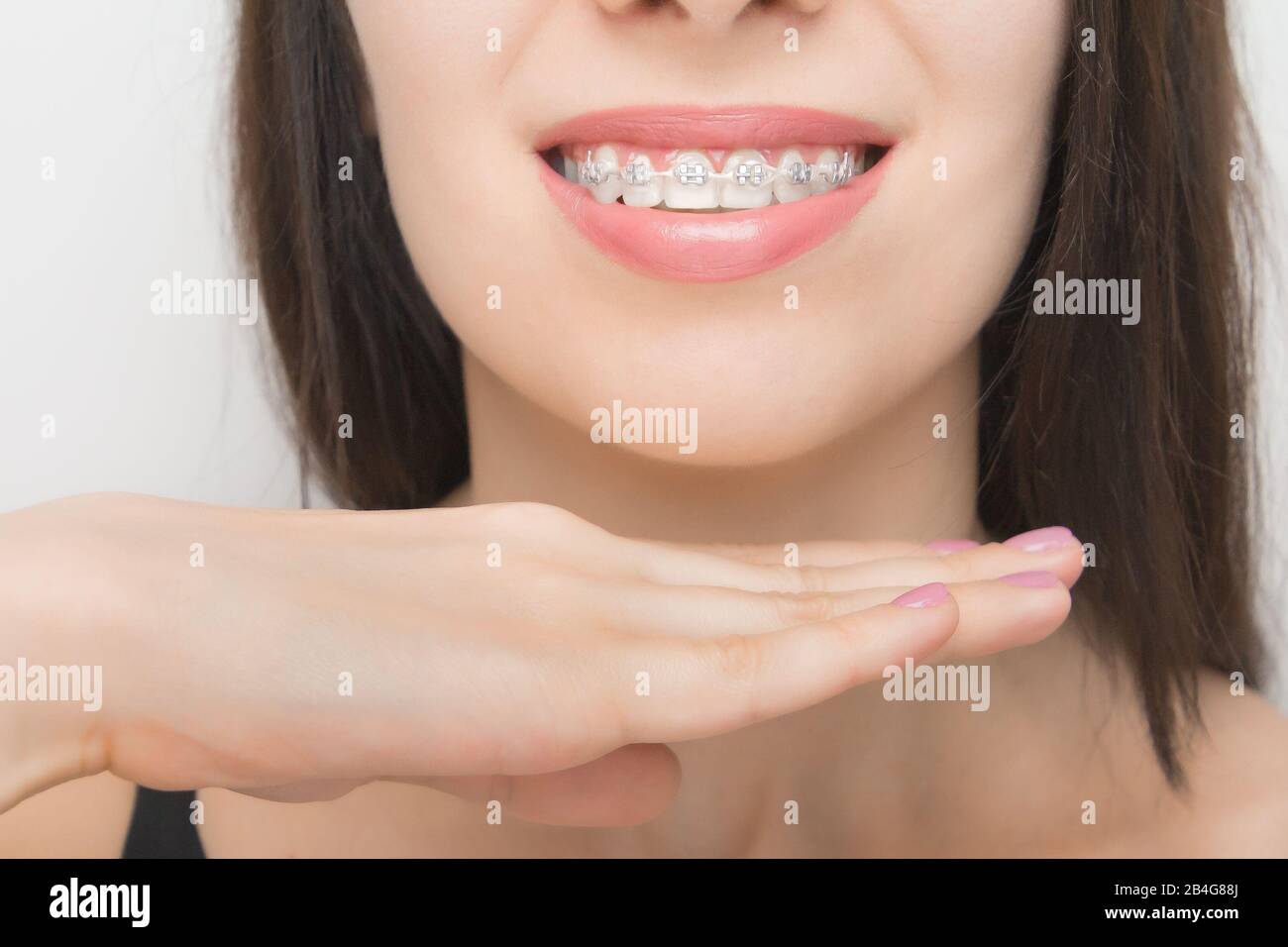 Showing White Teeth With Braces Stock Photo By ©didesign, 43% OFF