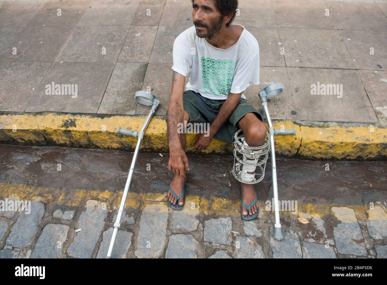 Olinda, Pernambuco, Brazil - June 06, 2016: Homeless Brazilian man in the streets of Olinda with bone screws after orthopedic surgery Stock Photo