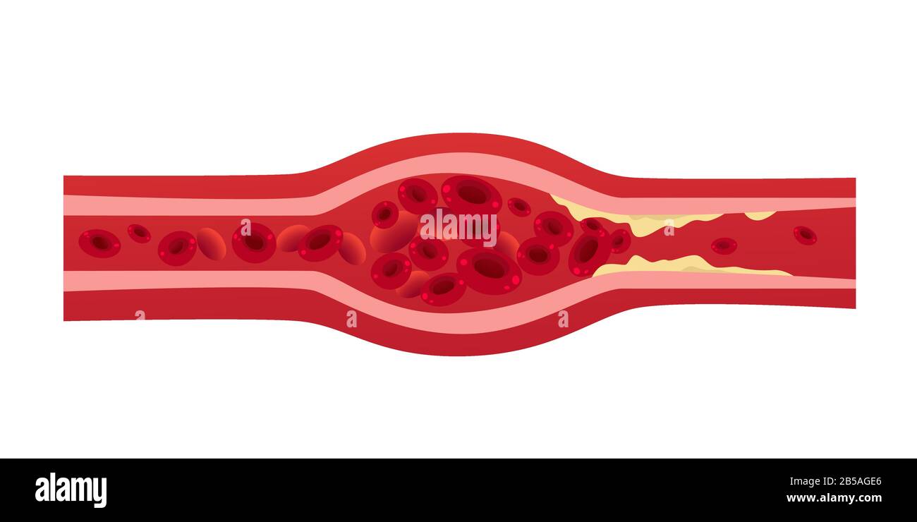 blocked blood vessel artery with cholesterol buildup cells creating blockage in artery thrombosis medical concept horizontal vector illustration Stock Vector