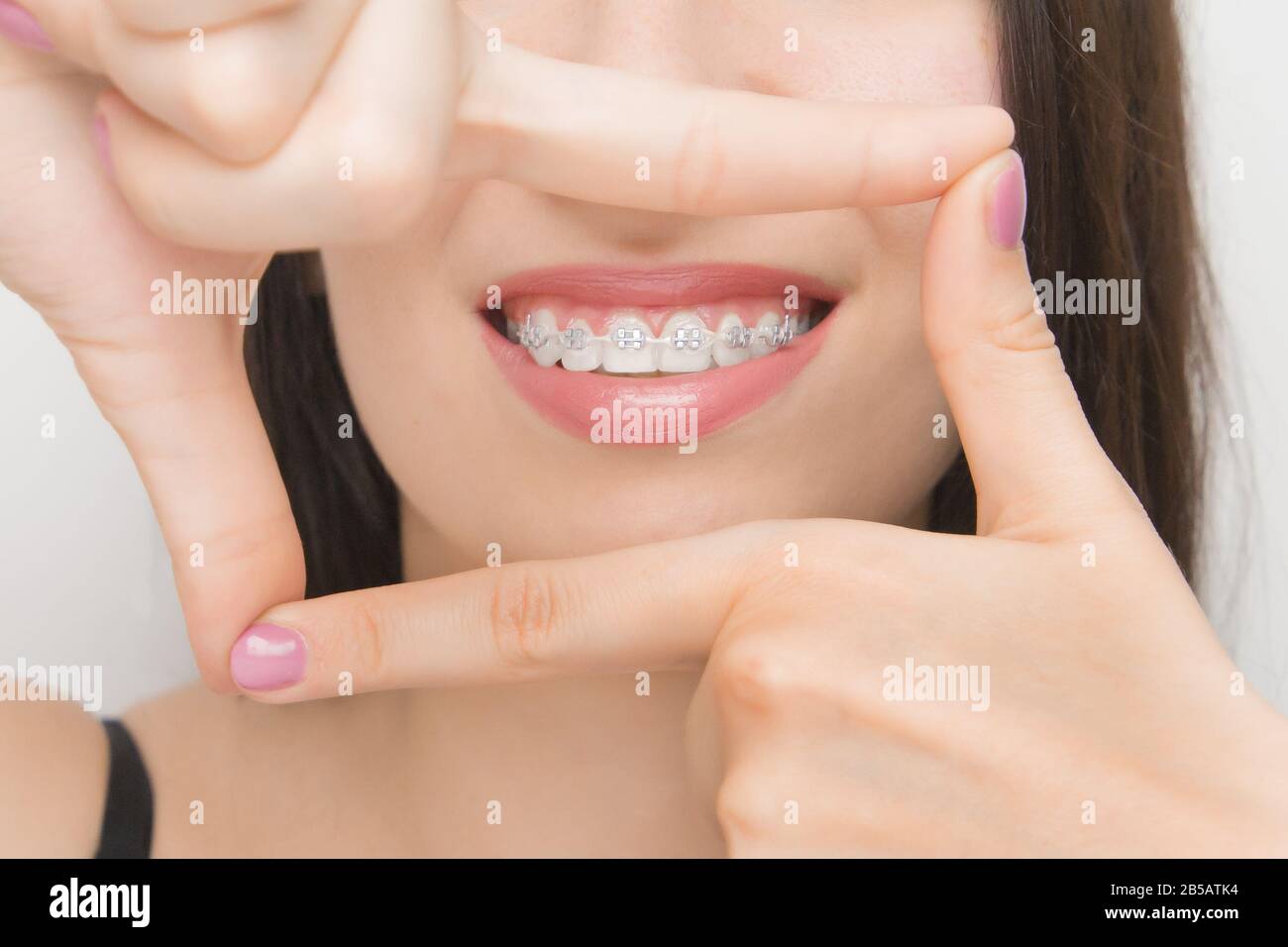 Dental braces in happy womans mouths through the frame. Brackets on the teeth after whitening. Self-ligating brackets with metal ties and gray Stock Photo