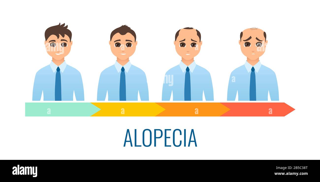 Male alopecia stages, illustration Stock Photo