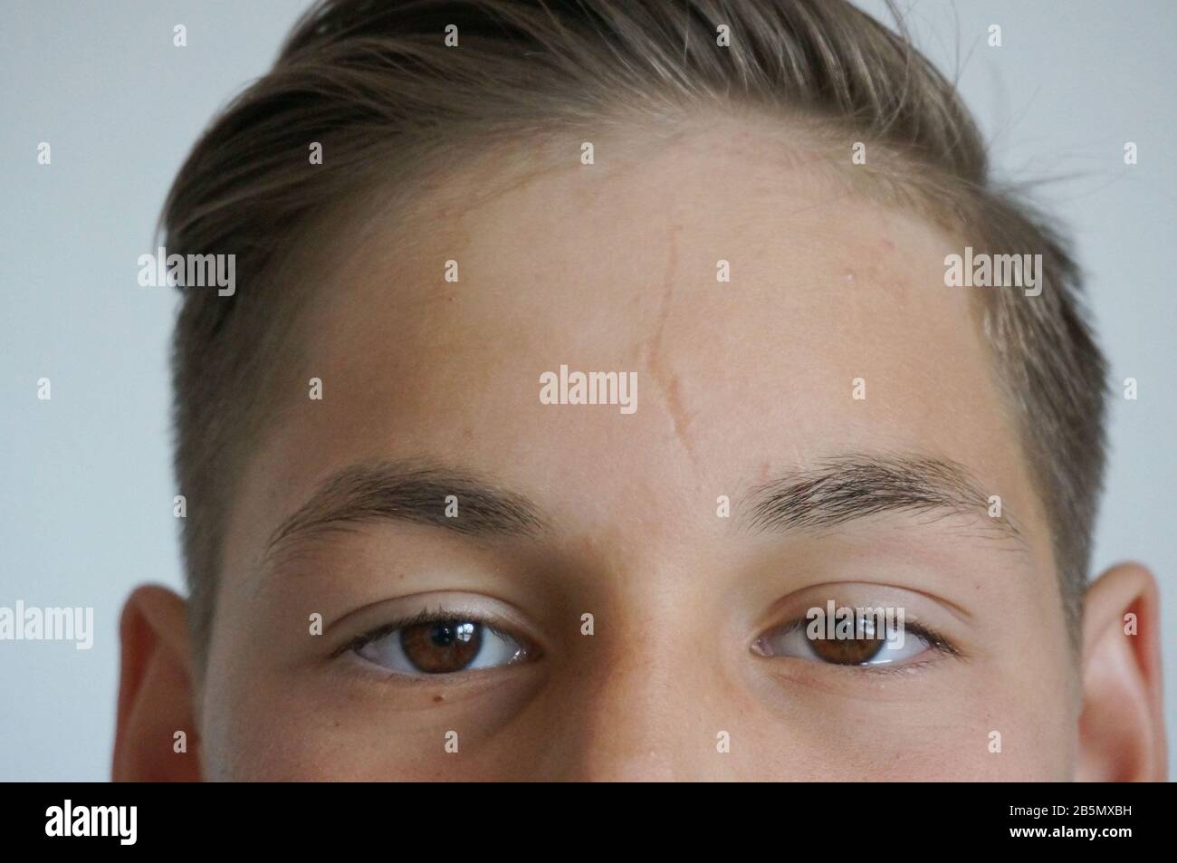 Teenager's forehead close up, young skin imperfection scar and acne Stock Photo