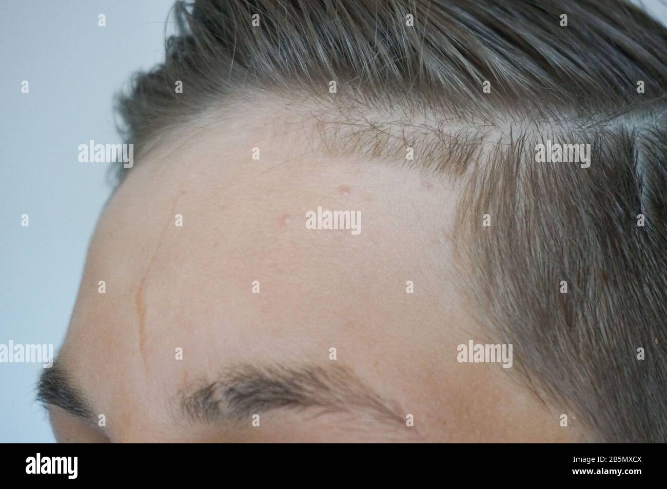 Teenager's forehead close up, young skin imperfection scar and acne Stock Photo