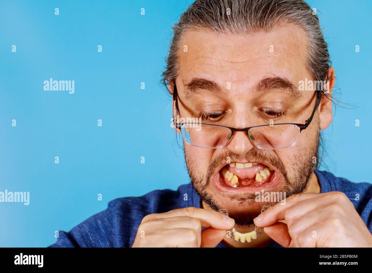 Removable temporary partial denture implantation of the patient Stock Photo Alamy