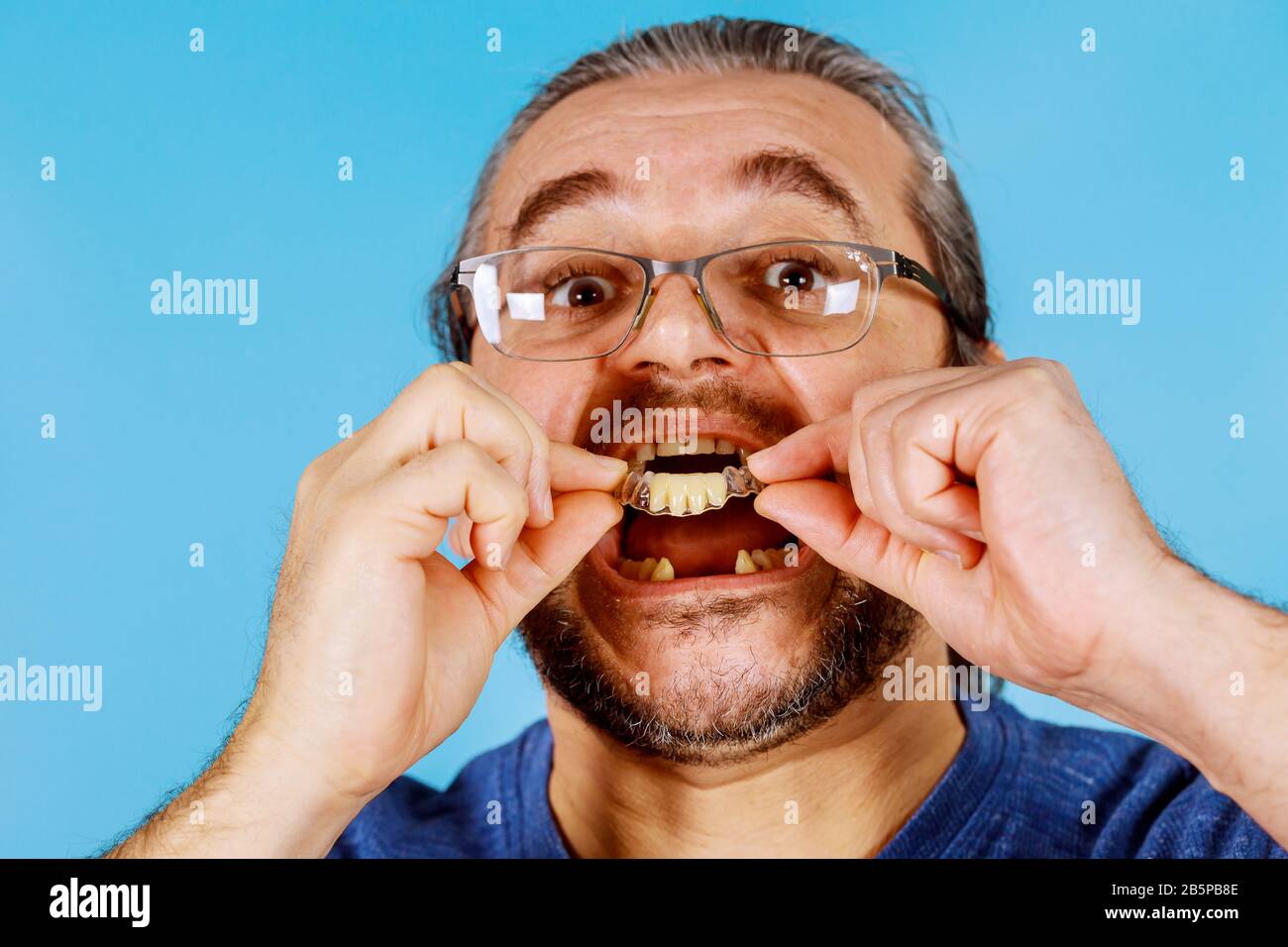 Man's hand putting dental implant temporary close-up in the patient Stock Photo