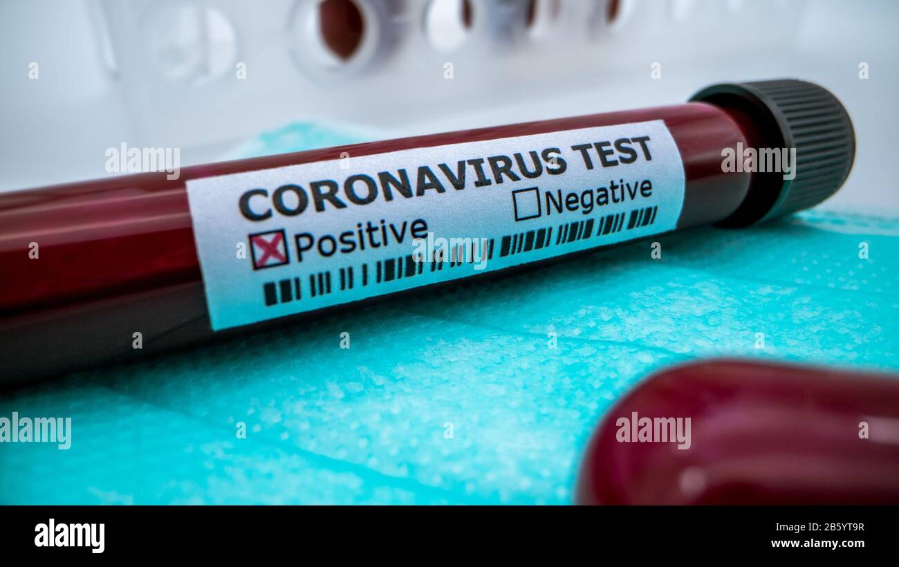 Protective mask and positive COVID-19 test. Laboratory sample of blood testing for diagnosis new Corona virus infection. Disease 2019 from Wuhan. Pand Stock Photo
