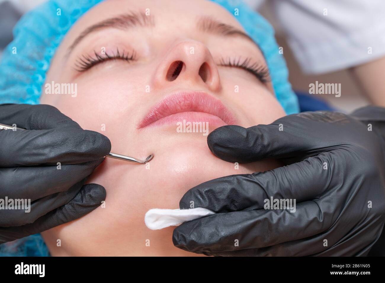 acne removal from a woman face with an extractor Stock Photo Alamy