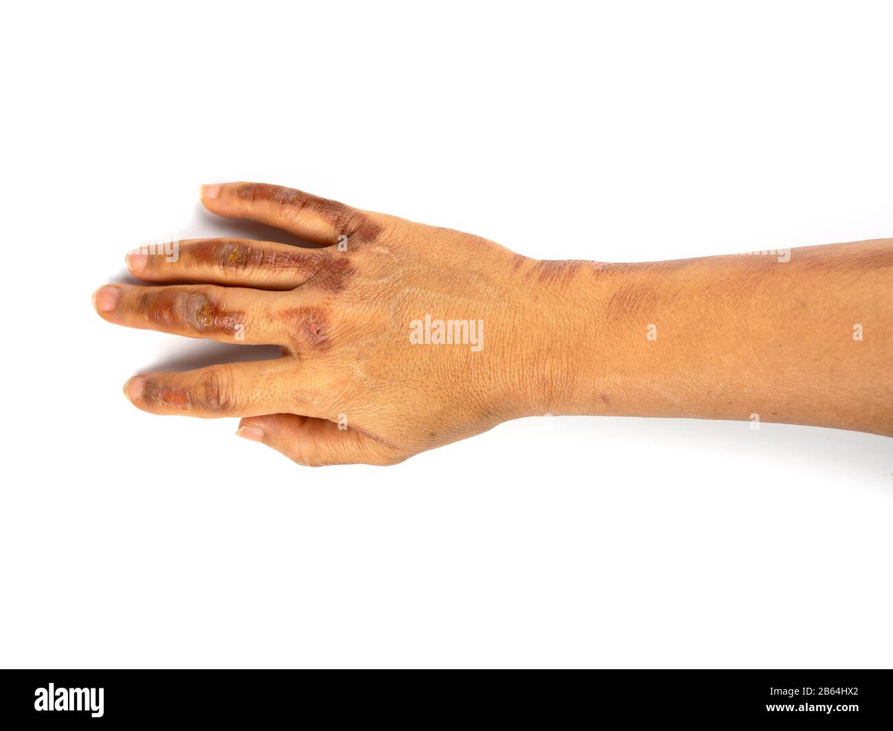 Burned Finger High Resolution Stock Photography and Images Alamy