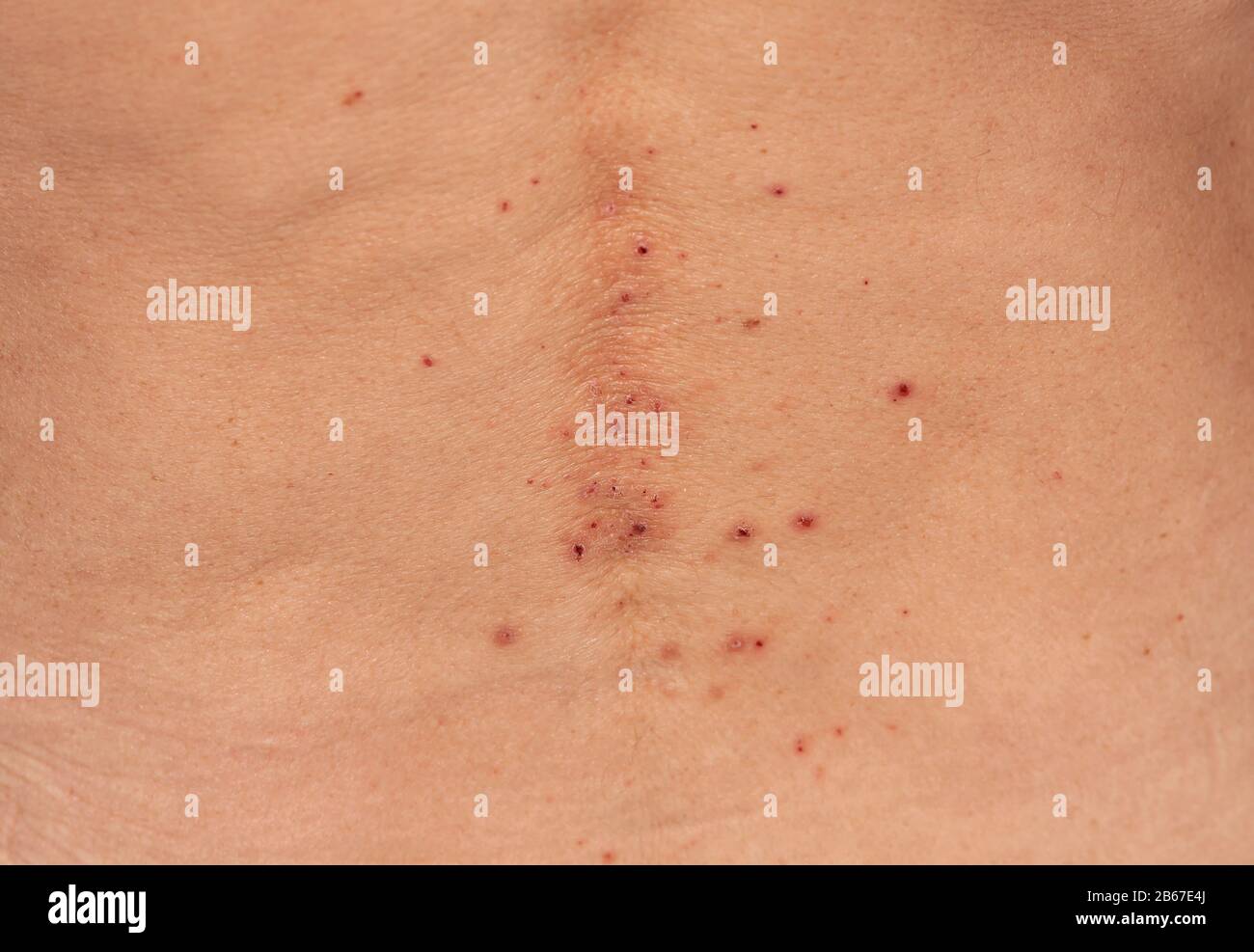 Neurodermatitis respectively atopic eczema Stock Photo