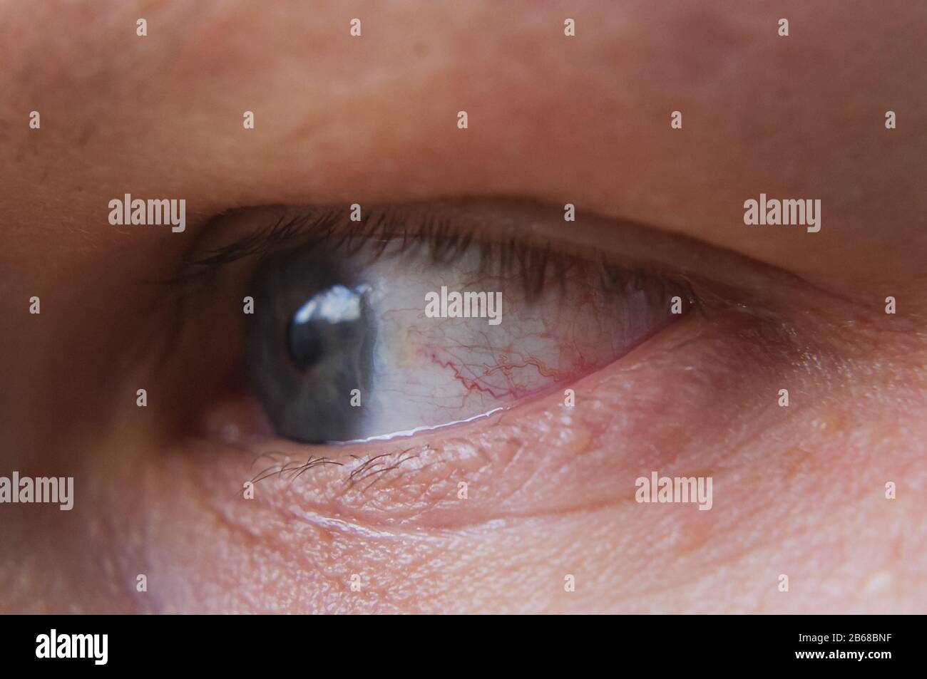 Macro close up red eye with conjunctivitis infection Stock Photo -