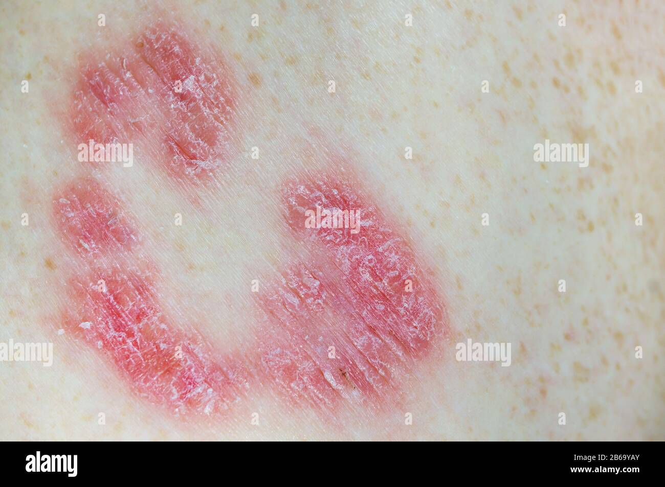 Inflamed psoriatic plaques on white skin. Macro photography Stock Photo