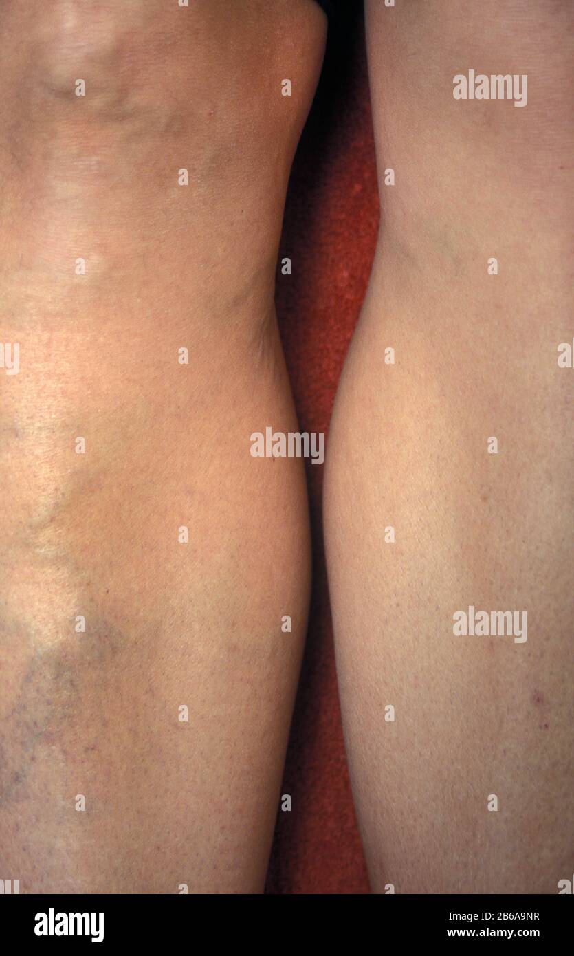 pair of female adults legs with varicose veins Stock Photo