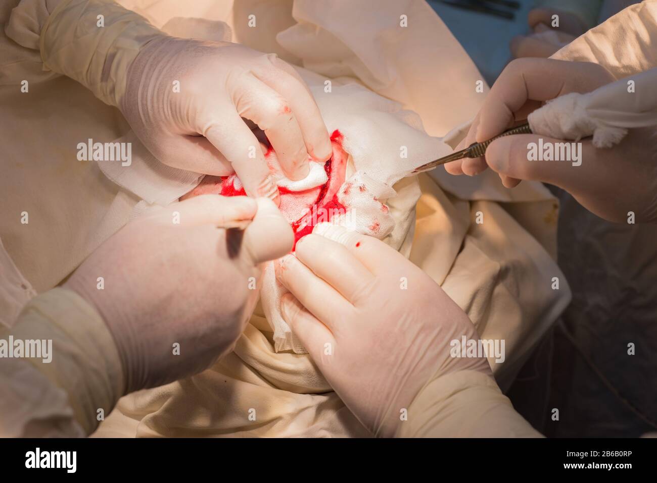 top view, stages of neurosurgical surgery for installing a titanium plate in the patients skull. Pediatric neurosurgery. Craniotomy. Incision of the s Stock Photo