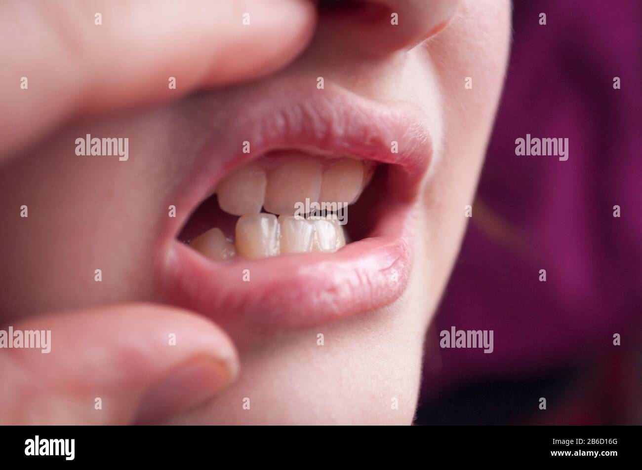 depicts a smiling child with his mouth wide open, showing his crooked teeth Stock Photo